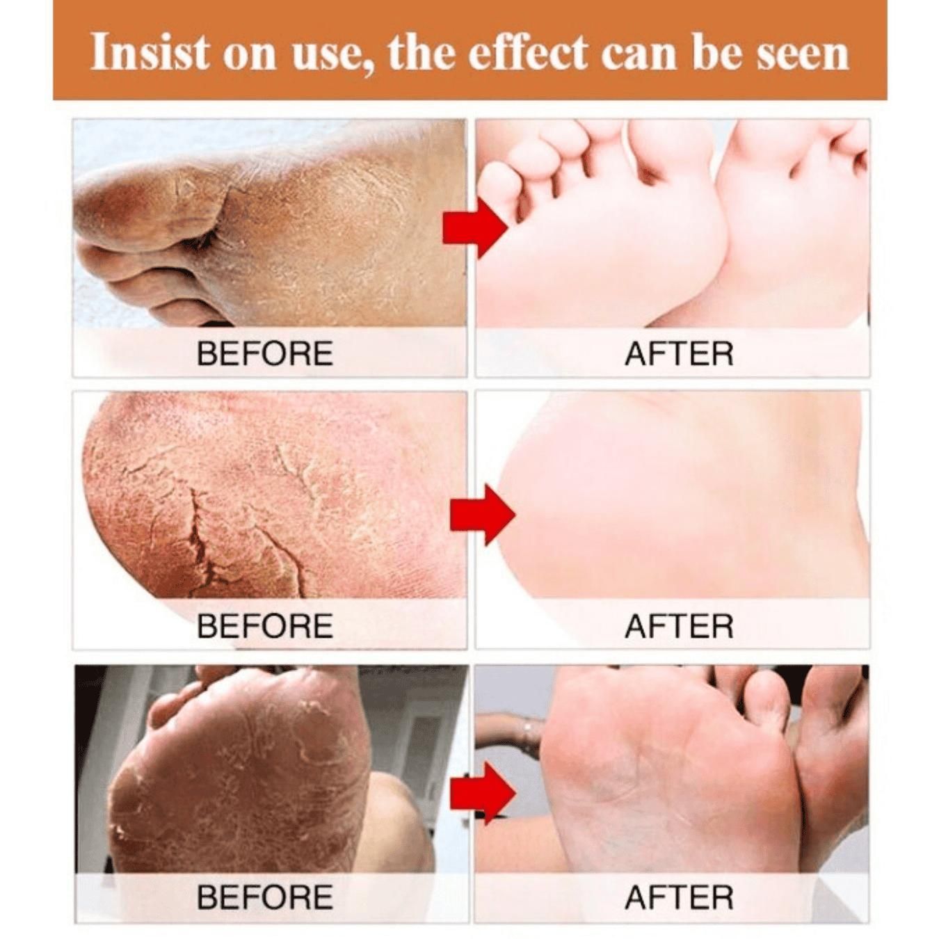 Foot Cream for Cracked and Dry Skin, Heel, Finger Healing Balm and Blaster 200 ml.